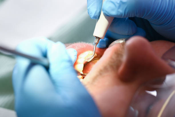 Best Emergency Dental Extractions in Cordele, GA